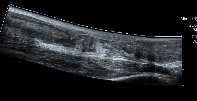 Achilles Tendon Scar Tissue